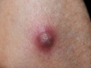 skin abscess