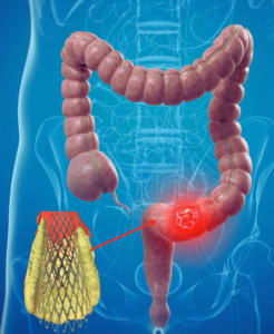 colon stent