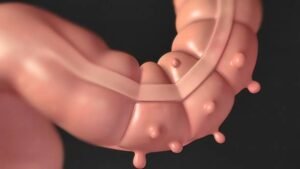 diverticular disease