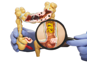 colon cancer surgery