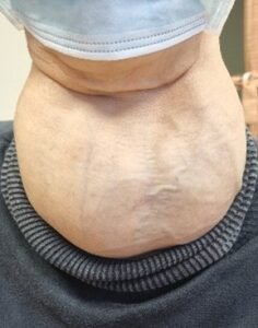 Thyroid Nodule in Singapore