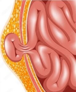 Hernia Surgery- Inguinal, Femoral, Incisional, Recurrence Hernia