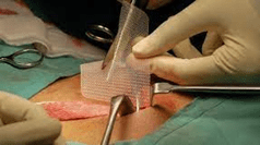 inguinal hernia surgery