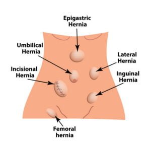 hernia types