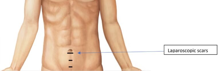 Laparoscopic (keyhole) inguinal hernia surgery