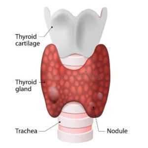 Thyroid Nodule in Singapore
