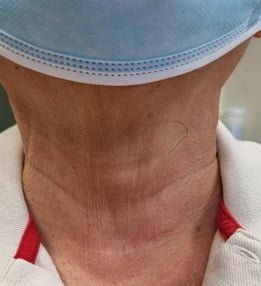 Scars once fully healed will look similar to natural skin creases