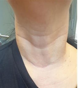 Scars once fully healed will look similar to natural skin creases