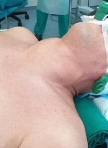 Patient’s position during thyroid surgery