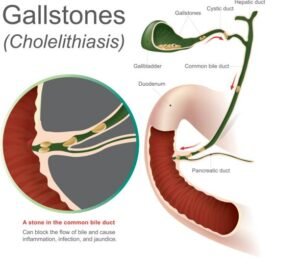 gallstones disease