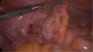 laparoscopic appendectomy for appendicitis