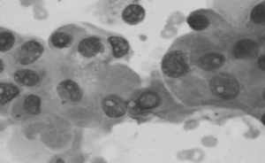 thyroid biopsy (fnac) cytology