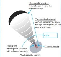 High-Intensity Focus Ultrasound