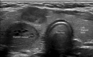 Ultrasound image of thyroid nodule