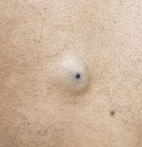 skin lesion; sebaceous cyst with a punctum