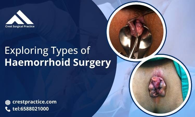 Exploring Types of Haemorrhoid Surgery