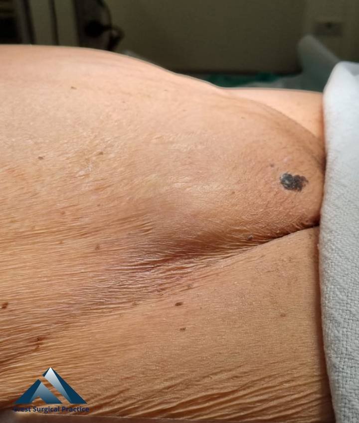 Inguinal Hernias in Women